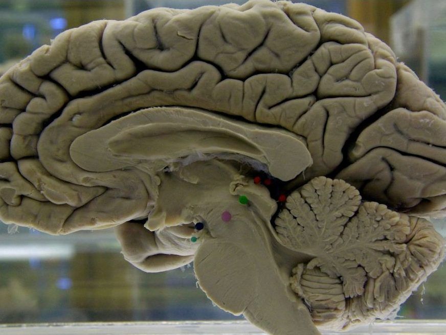 FILE - A section of a preserved human brain on display at the Museum of Neuroanatomy at the University at Buffalo, in Buffalo, N.Y., on Tuesday, Oct. 7, 2003.