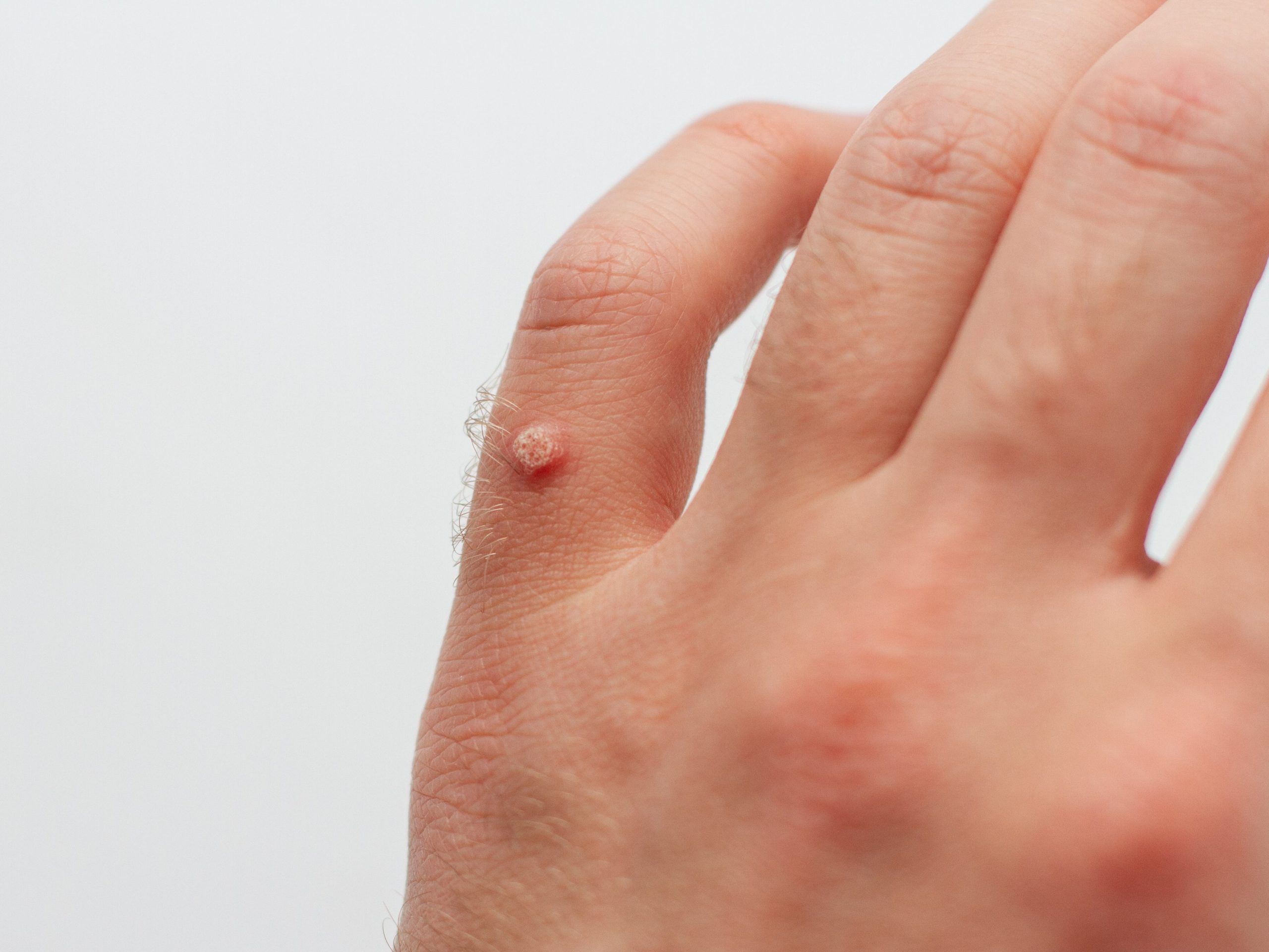 What you need to know about warts — and how to treat them at home