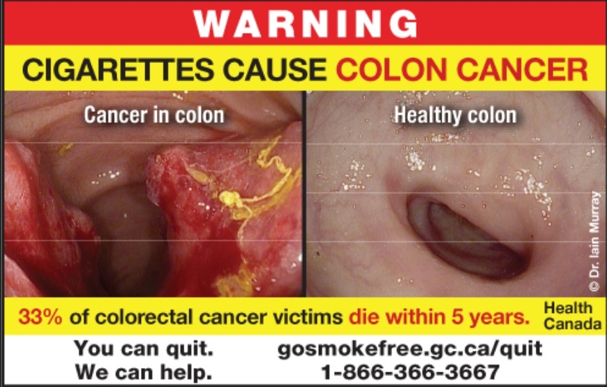  One of a new series of graphic warning images set to appear on Canadian tobacco packaging as of Aug. 1