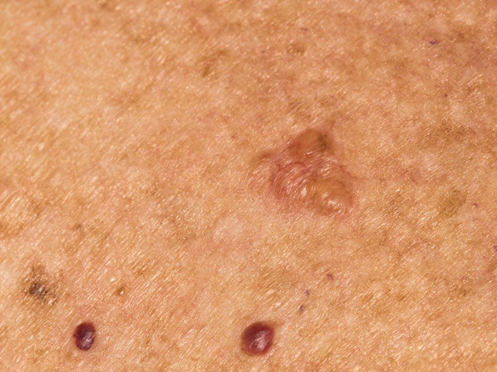 Basal cell carcinoma on the chest of a seventy year old Caucasian woman who has lived all her life in Africa
