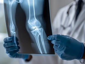doctor checking fracture in knee bone on medical imaging film