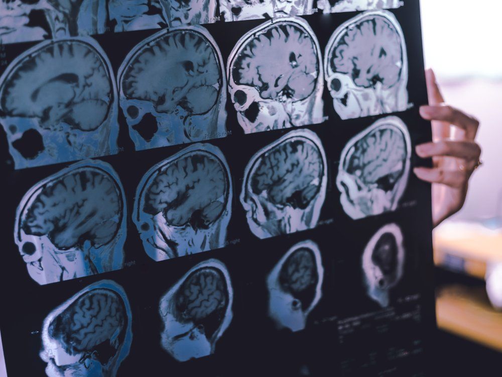 The dementia that often strikes in midlife — and the signs people miss