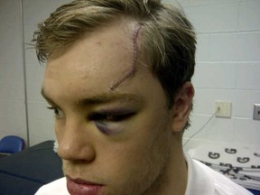 Taylor Hall's vicious injury after cutting his forehead on a skate blade during the pre-game warm-up in Columbus. (edmontonoilers.com PHOTO NOT FOR RESALE)