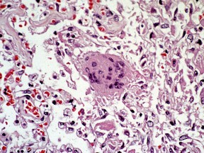 An image from a slide showing lung tissue infected due to Severe Acute Respiratory Syndrome (SARS) released April 23, 2003. REUTERS/Handout/Dr. Sherif Zaki/Centers for Disease Control