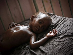 A malnourished and dehydrated child lies on a bed in Banadir hospital in Mogadishu. While several of the United Nations' development goals set at the dawn of the century have seen significant progress, reducing child and maternal mortality rates continue to be a challenge.