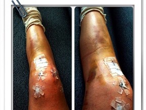 An image posted to Lindsey Vonn's Instagram page over the weekend shows the skier's serious leg injuries.