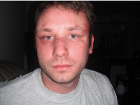 Jason Stern is seen after the 2010 beating by Barrie Const. Jason Nevill.