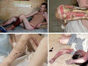 Krokodil, the flesh-eating homemade drug popular in Russia appears to have hit Canada.

(Facebook group Krokodil Russia's Deadliest Drug/QMI AGENCY)