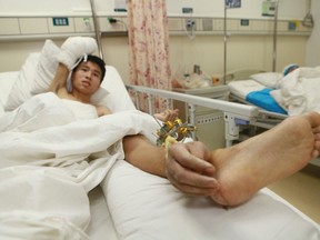Xiao Wei's severed right hand is seen attached to his ankle before undergoing the reattachment surgery at Xiangya Hospital in Changsha, Hunan province, in this December 4, 2013 handout photo provided by Xiangya Hospital, Central South University. (REUTERS/Xiangya Hospital, Central South University/Handout via Reuters)