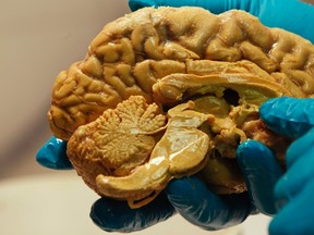 Hungarian scientist Tamas Freund holds a human brain at the Institute of Experimental Medicine of Hungarian Academy of Science in Budapest in this March 16, 2011 file photo. (REUTERS/Laszlo Balogh/Files)