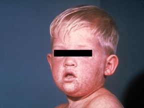 Unvaccinated children are particularly at risk of measles. (PHOTO SUBMITTED)