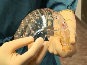 Doctors in the Netherlands have replaced a woman's skull with a plastic one made using a 3D printer. (YouTube screengrab)