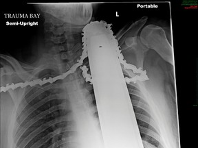 A chest x-ray shows the chainsaw that was embedded in James Valentine's neck and shoulder, courtesy of the Allegheny Health Network, received April 1, 2014. REUTERS/Allegheny Health Network/Handout via Reuters