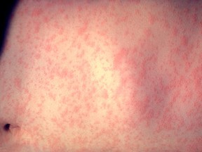 The rash-like symptom from the measles virus. (Wikipedia Creative Commons photo)