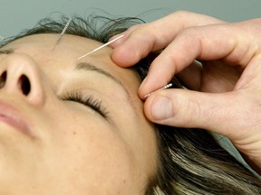 Acupuncture pinpoints the spot where people actually store their stress or pain. (FILE PHOTO)