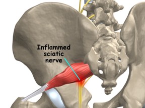 Anyone who has been unfortunate enough to know what sciatica feels like will be able to tell you, the pain is excruciating and usually runs right down the leg. A small percentage of people are prone to irritating that nerve because it is in that muscle.