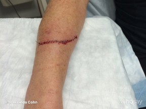 Linda Cohn's arm after the New York arena incident. (Twitter)