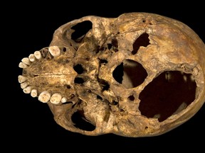 An undated handout picture released on February 4, 2013 from the University of Leicester shows the base of the skull of king Richard III with the two potentially fatal injuries.  AFP PHOTO/HO/UNIVERSITY OF LEICESTER