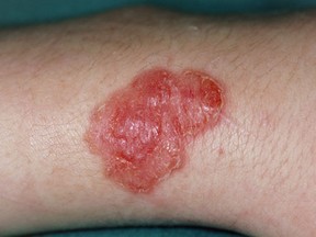 Scabies bite on an arm.