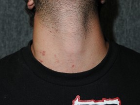 Court exhibit of Justin Spring, 19, brother of accused killer Matthew Spring, with red marks on his neck. The defence says he was being strangled by Bradley Hubbard.