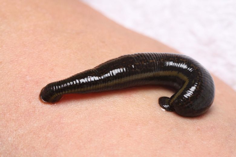 3-inch leech pulled from Scottish backpacker's nose | Toronto Sun