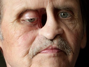 David Whenham suffered for years after cancer surgery left him with a gaping hole in his face. FILE