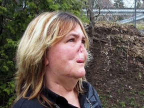 Marie-Helene Tokar, shown here in a file photo from April 2011, was disfigured after being attacked by a pit bull in 2008. (QMI Agency)