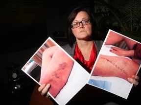 Lawyer Angela McLeod on Dec. 17, 2014, holds photographs showing client Marie Farrell’s badly bruised leg and aftermath of surgery after incident with OPP officer. (Tracy McLaughlin photo/Special to the Toronto Sun)
