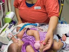 Conjoined twins Knatalye Hope Mata (top) and Adeline Faith Mata are pictured with their mother Elysse Mata at Texas Children's Hospital in Houston in this July 25, 2014 handout photo obtained by Reuters October 9, 2014.   REUTERS/Allen Kramer/Texas Children's Hospital/Files