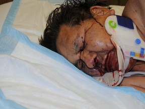 Andrew Mixemong in hospital before he died. Mixemong's family requested that media use this photo so the public would know about the viciousness of his fatal beating. (Handout/Toronto Sun)