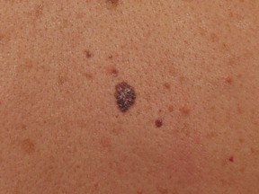 mole on skin