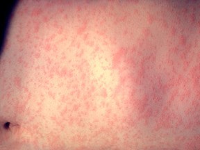 The rash-like symptom from the measles virus. (Wikipedia)