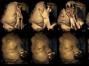 Researchers from England's Durham University did 4-D scans of 20 fetuses between 24-36 weeks along. Sixteen of the fetuses had mothers who didn't smoke, while four of them had mothers who smoked an average of 14 cigarettes a day.  (Durham University)