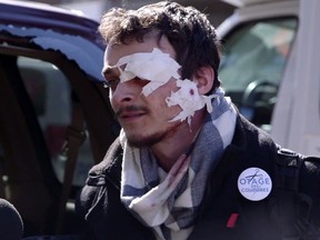 Nicolas Bourgois, 22, needed nine stitches to his eyelid and three to his leg after he claims a police officer used his head to shatter the rear window of a van during a march Thursday against austerity measures by the Quebec government. Photo courtesy of Julien Beaumier
