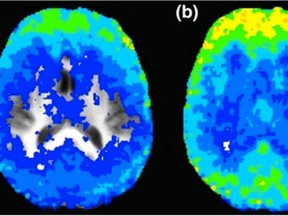 In these brain scans, blue represents a more chaotic brain, while yellow shows less chaos. Chaos in the brain allows it to react to different situations These images show a person's brain before drinking six ounces of whisky (left), immediately after drinking the whisky (middle) and 90 mins after drinking (right). MCMASTER HANDOUT PHOTO