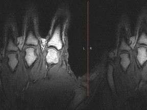 A pair of undated handout images courtesy of the University of Alberta in Edmonton, Canada show what happens inside finger joints to cause the distinctive popping sounds heard when cracking knuckles. Figure 1 reveals normal metacarpophalangeal joints with the expected lack of any gaseous cavity prior to joint distraction and in Figure 2 following the cracking event, static imaging with the addition of MCP distraction yielded a dark intra-articular void. Researchers said on April 15, 2015 they have settled the issue of what occurs inside knuckles to trigger the familiar popping sound, thanks to magnetic resonance imaging (MRI) experiments that they jokingly dubbed the "pull my finger study."