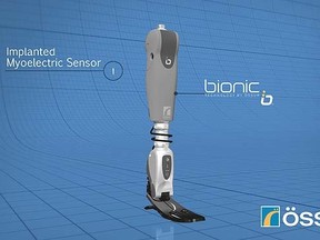 Osur's bionic limb. (Video screenshot)
