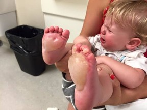 Brampton one-year-old Greyson Pelvin's blistered feet after stepping on hot metal at a Georgetown splash pad. (Facebook)
