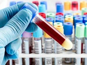 Pathway launches 'liquid biopsy' to find cancer. (Fotolia)