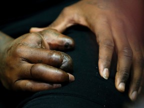 The mangled hand of New York Giants defensive end Jason Pierre-Paul is seen as he speaks to reporters Friday, Oct. 30, 2015, in East Rutherford, N.J. (AP Photo/Julio Cortez)