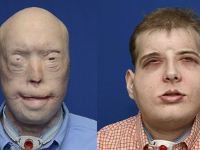 Volunteer firefighter Patrick Hardison, 41, of Senatobia, Mississippi is shown in this composite photo showing before-and-after face transplant surgery in this undated handout provided by NYU Langone Medical Center n New York, November 16, 2015. Hardison, whose face was burned off during a rescue is the recipient of what surgeons called the most extensive face transplant ever, performed at a New York hospital. REUTERS/NYU Langone Medical Center/Handout via Reuters