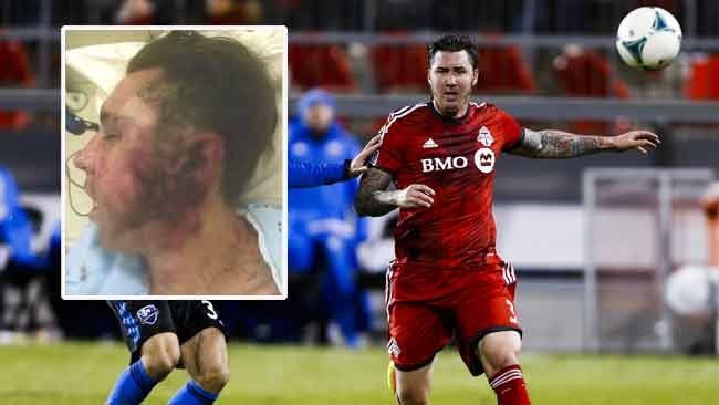 Former Toronto FC defender Danny Califf severely injured by