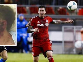 Former TFC defender Danny Califf claims an exploding e-cigarette mangled his face.