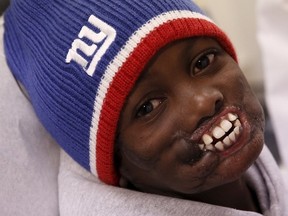 Dunia Sibomana, 8, who was attacked two years ago by a chimpanzees in his village in the Democratic Republic of Congo, smiles at Stony Brook Children's Hospital in Stony Brook, New York January 6, 2016. Doctors at Stony Brook Children's Hospital will begin a series of extensive facial reconstructive surgeries on Sibomana on Monday. REUTERS/Shannon Stapleton