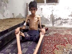 This undated photo posted on the Local Revolutionary Council in Madaya, which has been verified and is consistent with other AP reporting, shows a starving boy in Madaya, Syria. (Local Revolutionary Council in Madaya via AP)