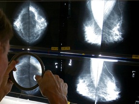 A radiologist uses a magnifying glass to check mammograms for breast cancer in Los Angeles. Mammograms do the most good later in life, a government task force said Monday in recommending that women get one every other year starting at age 50, and that 40-somethings make their own choice after weighing the pros and cons. (AP Photo/Damian Dovarganes, File)