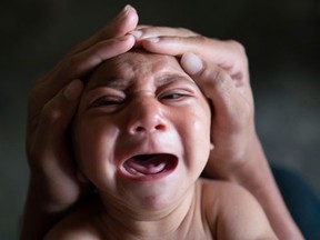 FILE - In this Jan. 30, 2016 file photo, Jose Wesley, who was born with microcephaly and screams uncontrollably for long stretches, is attended to in Bonito, Pernambuco state, Brazil. The Zika virus is drawing worldwide attention to a devastating birth defect that until now has gotten little public notice. Regardless of whether the mosquito-borne virus really causes babies to be born with abnormally small heads, a variety of other conditions can trigger it.  (AP Photo/Felipe Dana, File)