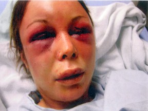 A slashed, burned and beaten Aimee Raycraft lies in a hospital bed in December 2013 after escaping from her tormentors. (Supplied photo/Toronto Sun)