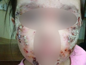 A young girl from Kashechewan with one of the more severe cases of the rashes experienced by children in the community. The photo has been altered to protect her identity. (Supplied Photo)