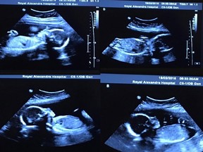 Tim and Bethani Webb were thrilled when they learned they were expecting a child shortly after getting married in northwestern Alberta last June. Since then they have discovered they are expecting identical quadruplet girls, a 1 in 67 million occurrence. An ultrasound of the quadruplets is shown in a handout photo. THE CANADIAN PRESS